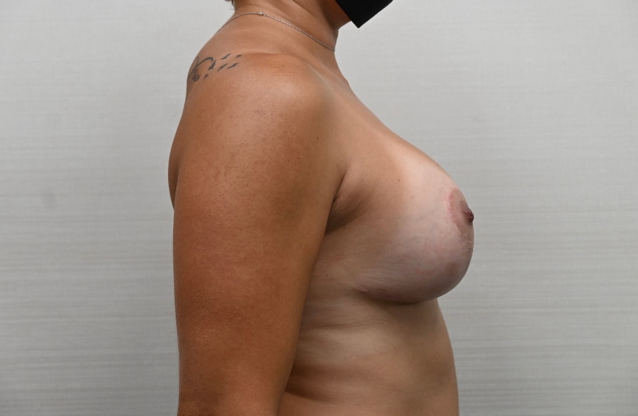 Mastopexia Con Implantes Before & After