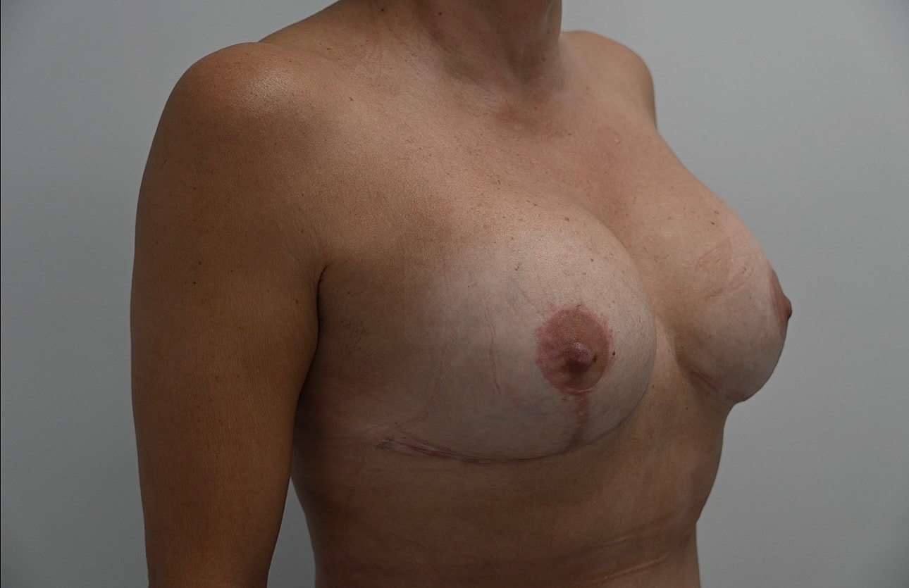 Mastopexia Con Implantes Before & After