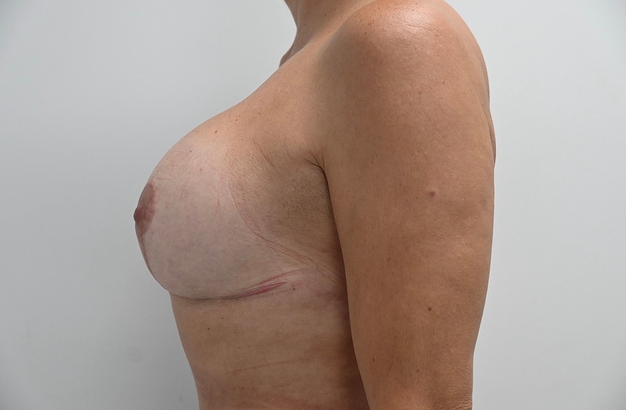 Mastopexia Con Implantes Before & After