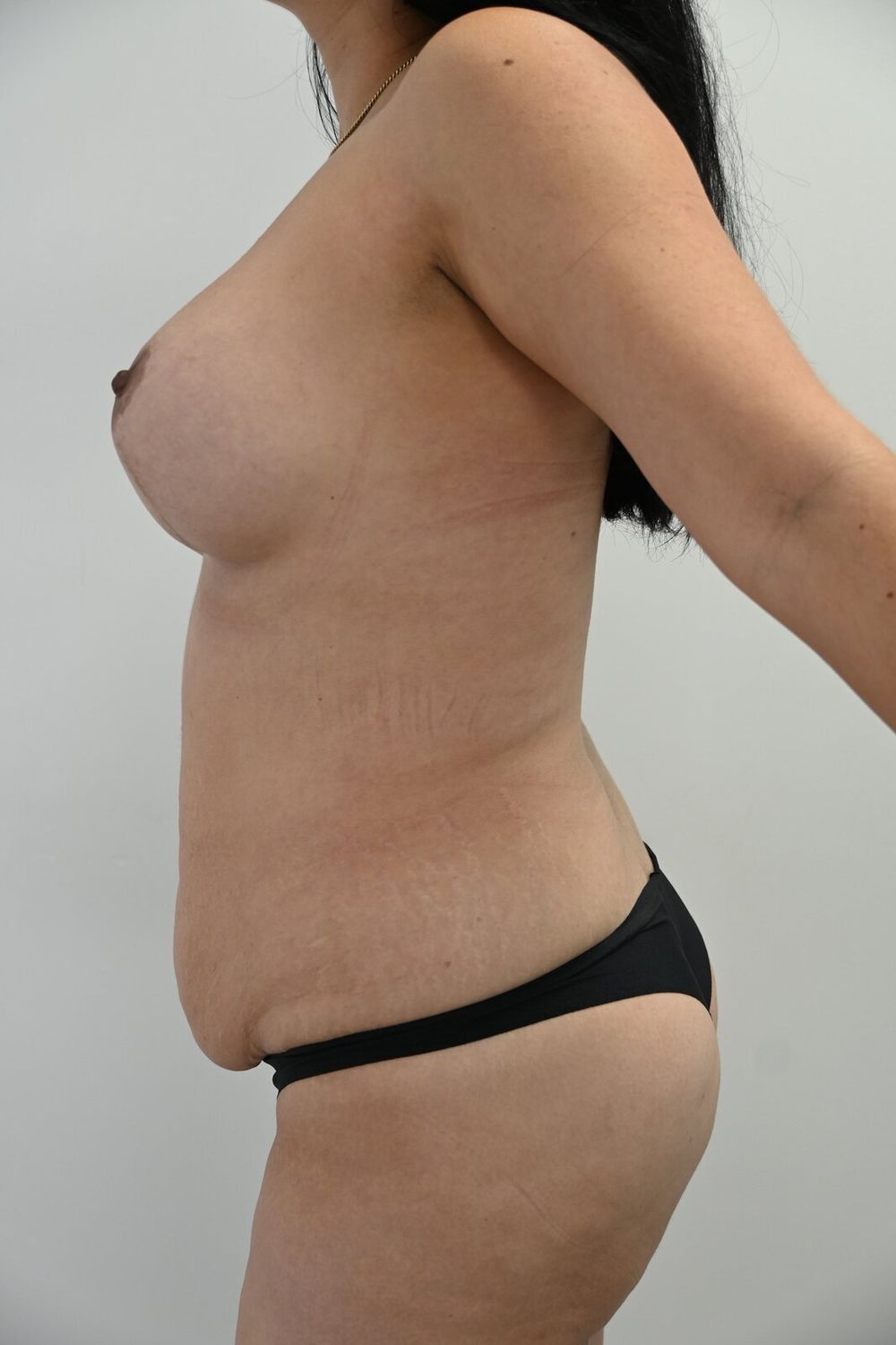 Abdominoplastia Before & After