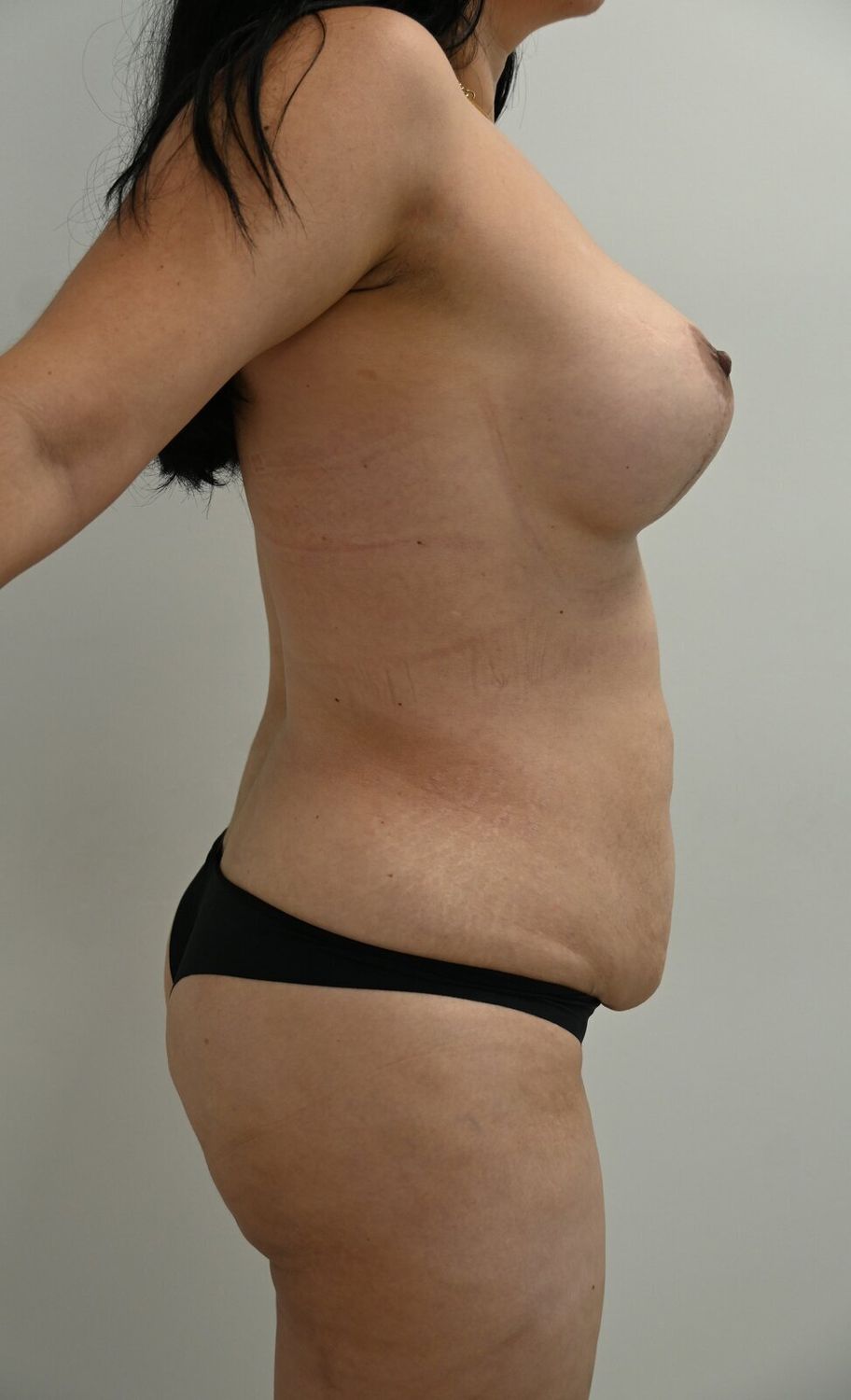 Abdominoplastia Before & After