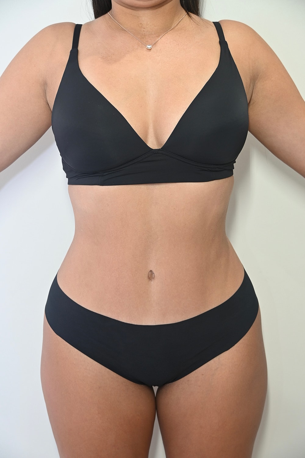 Abdominoplastia Before & After