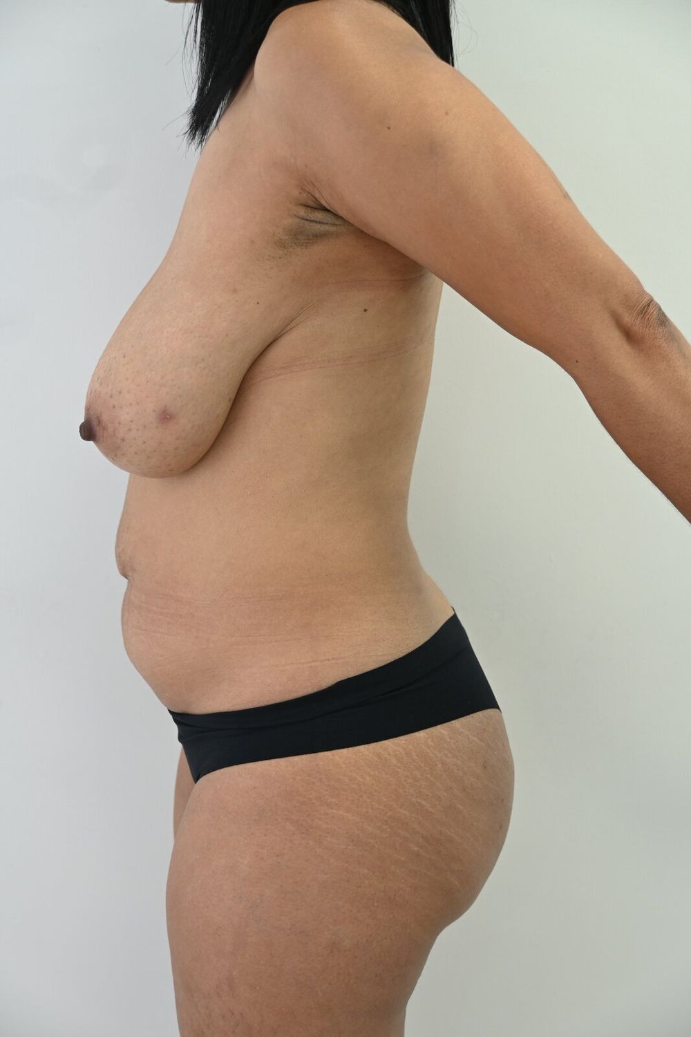 Abdominoplastia Before & After