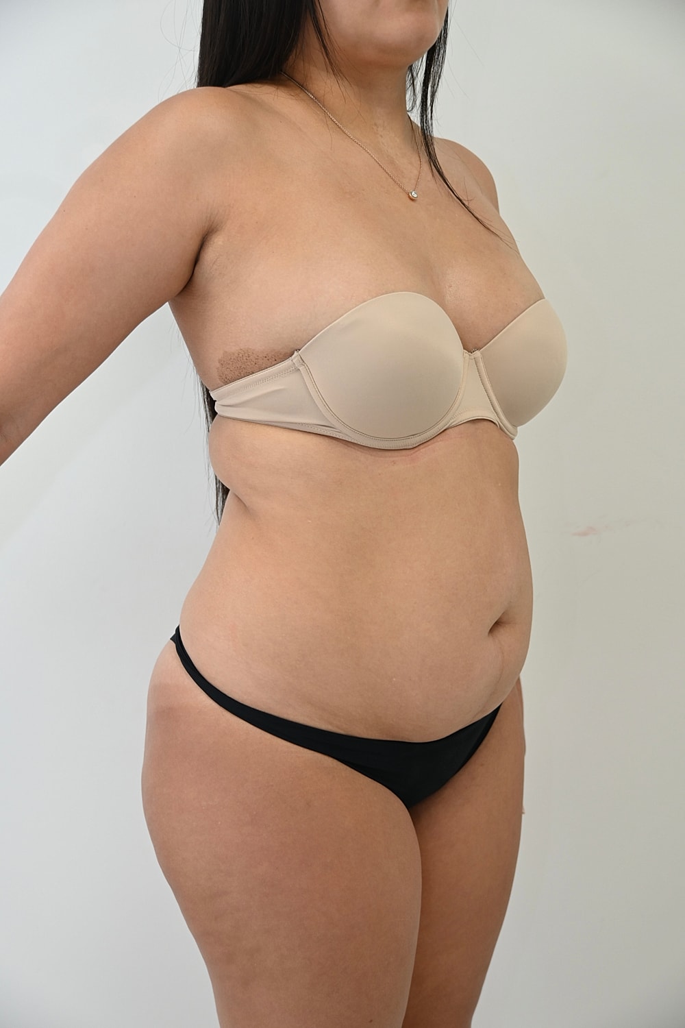 Abdominoplastia Before & After