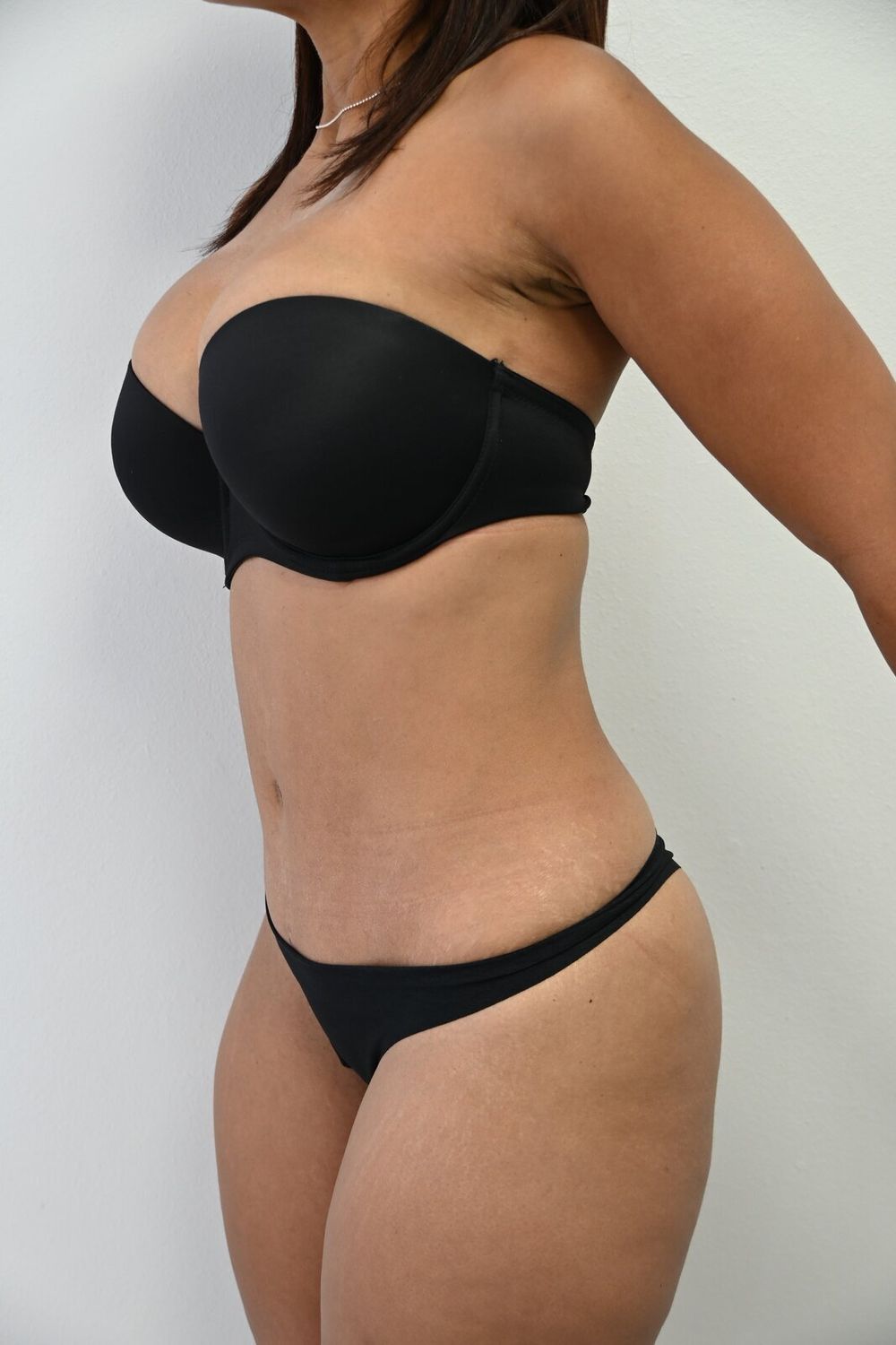 Abdominoplastia Before & After