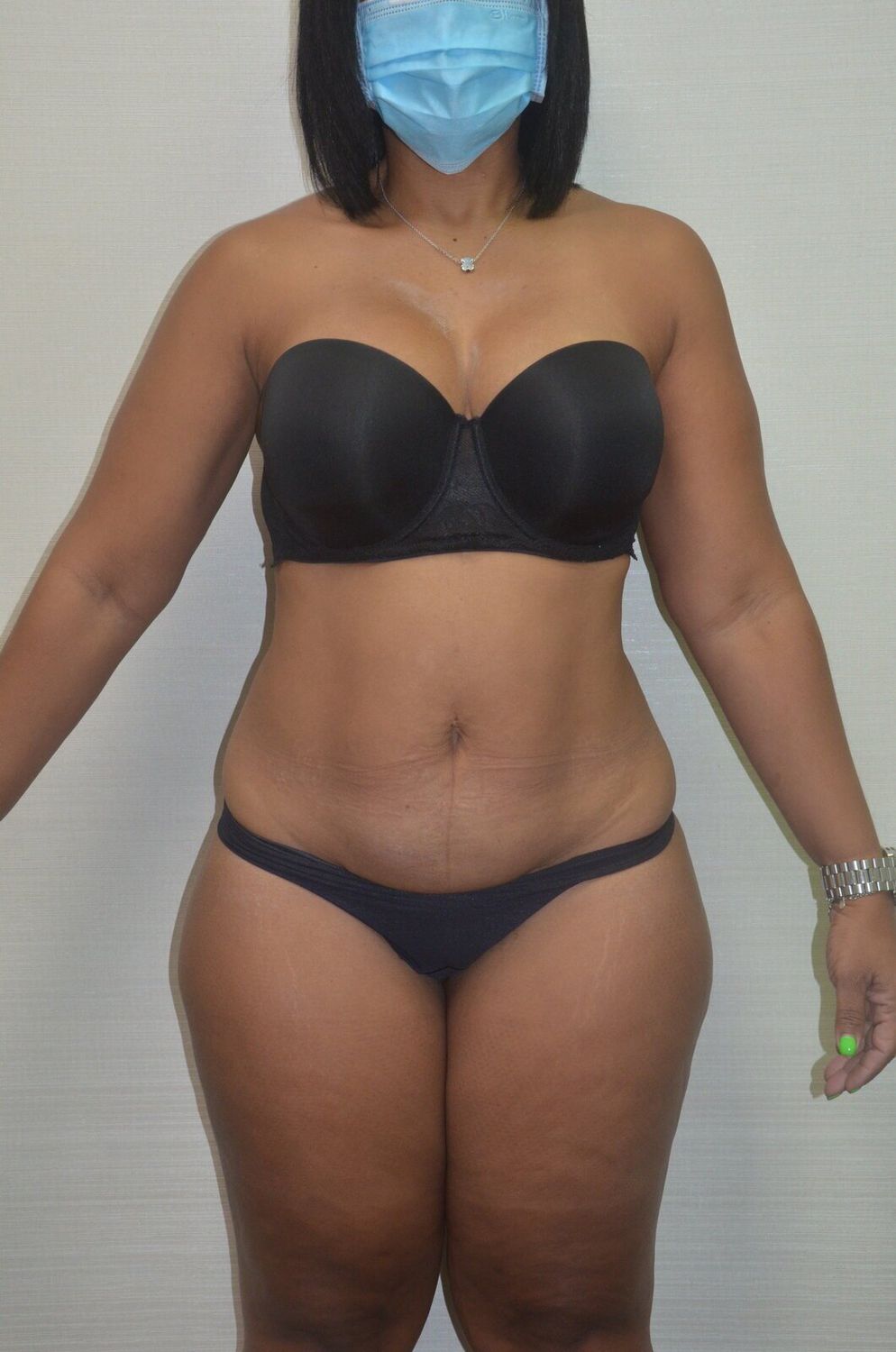 Abdominoplastia Before & After