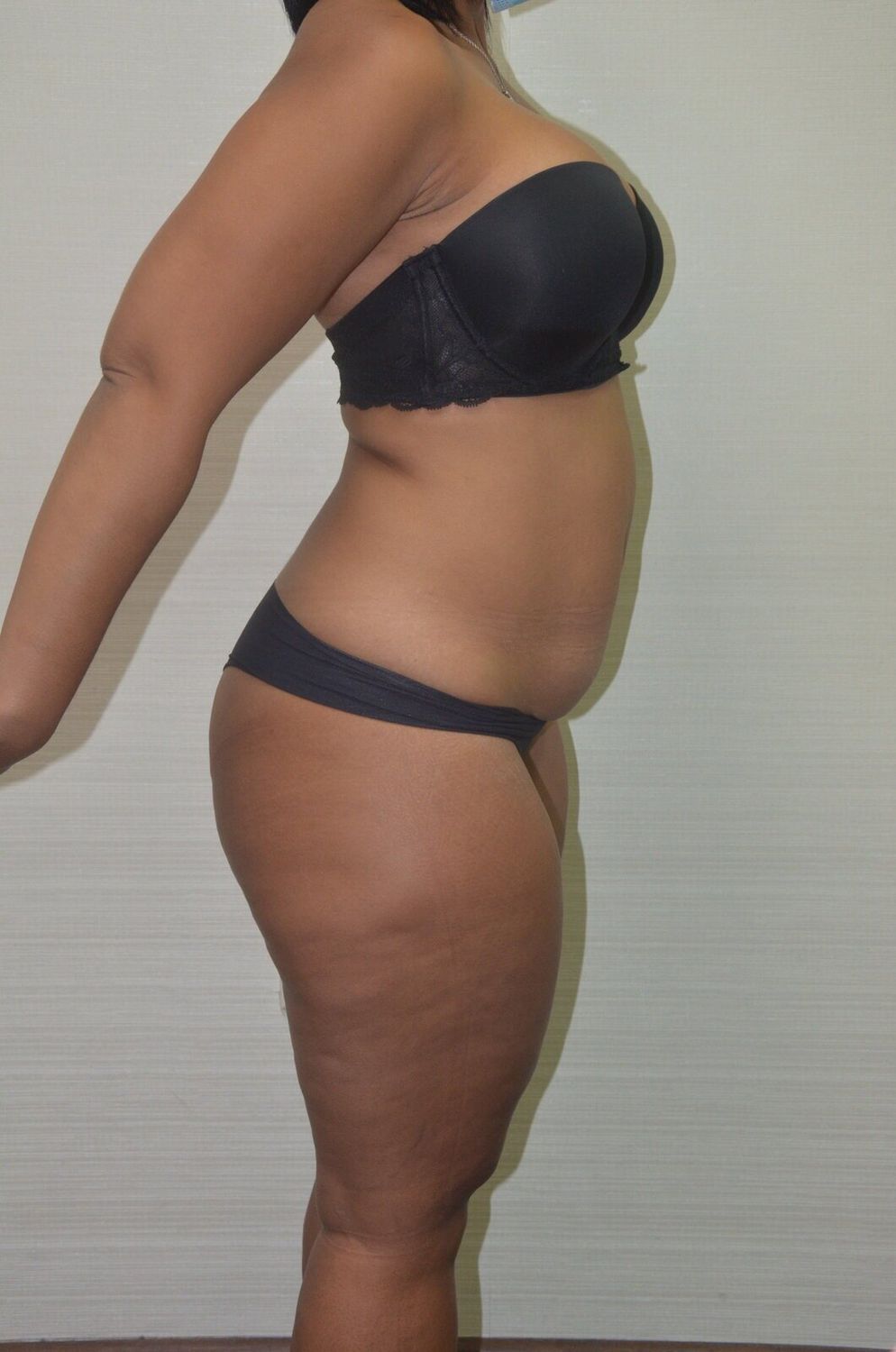 Abdominoplastia Before & After