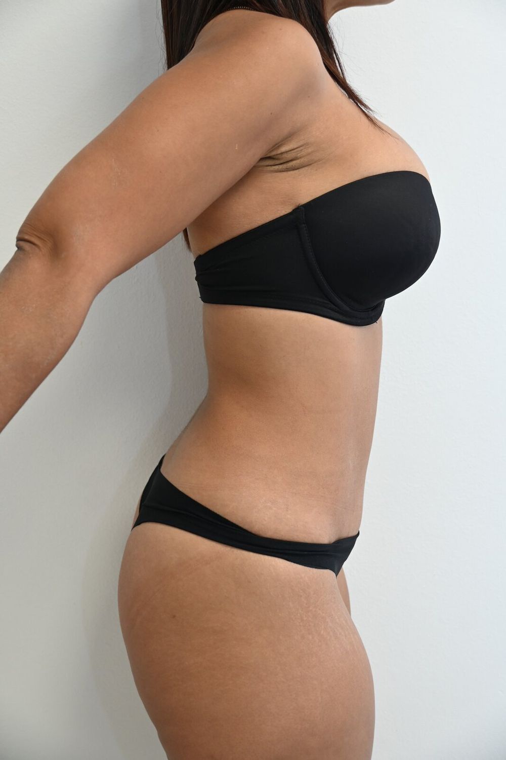 Abdominoplastia Before & After