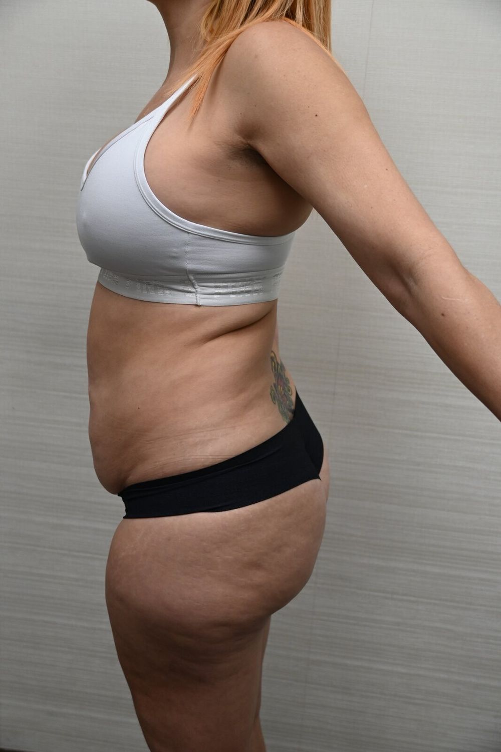 Abdominoplastia Before & After
