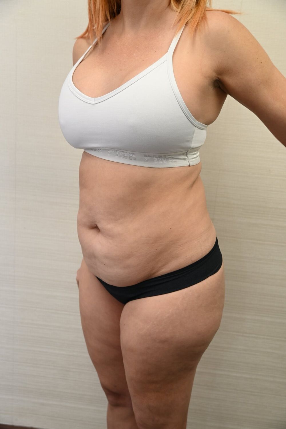 Abdominoplastia Before & After