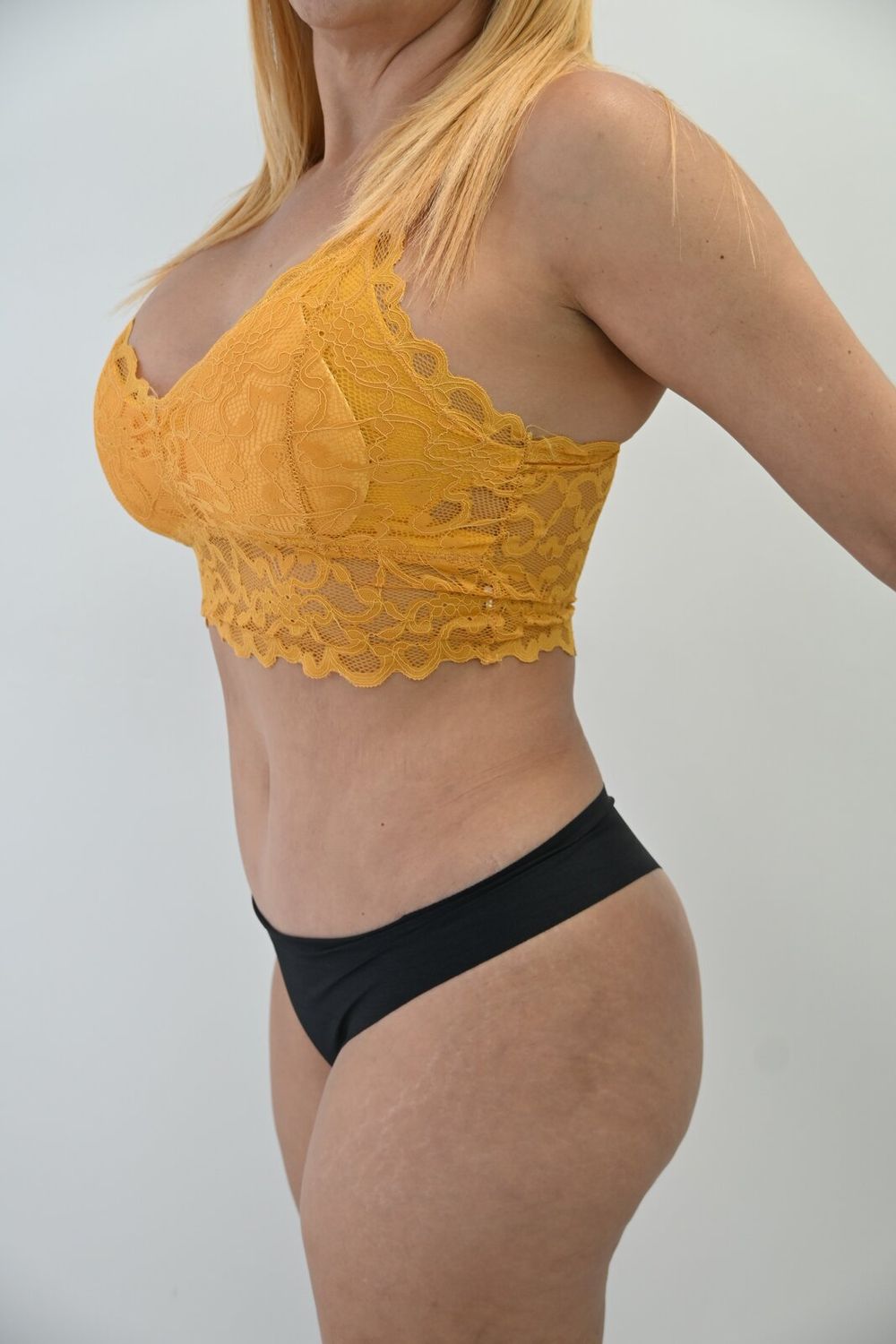 Abdominoplastia Before & After