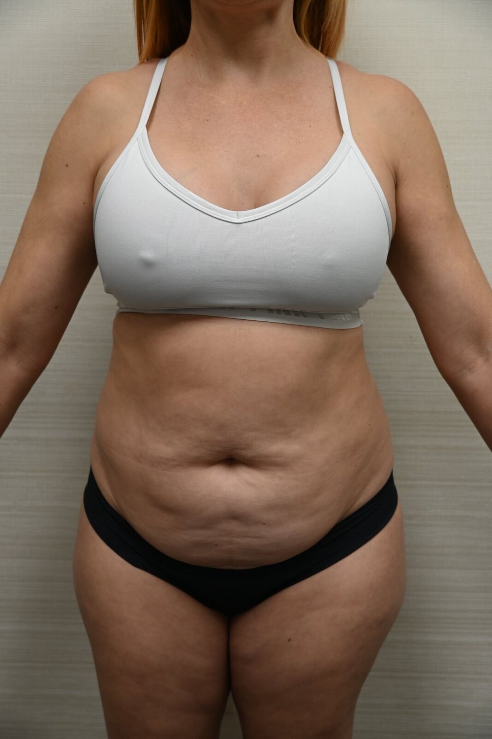 Abdominoplastia Before & After