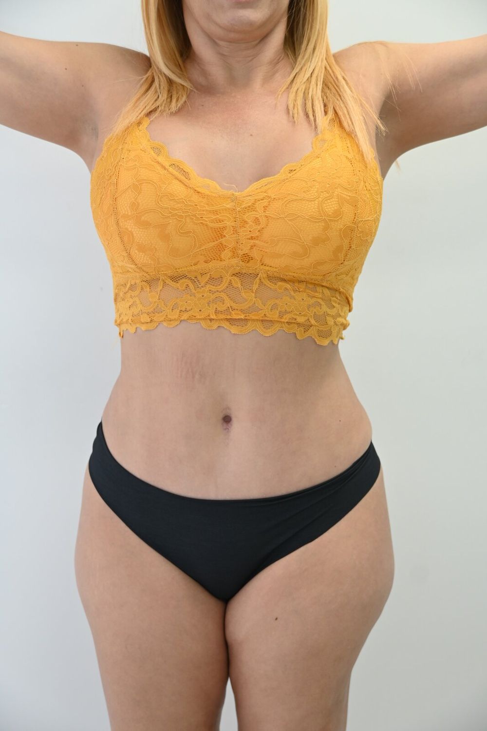 Abdominoplastia Before & After