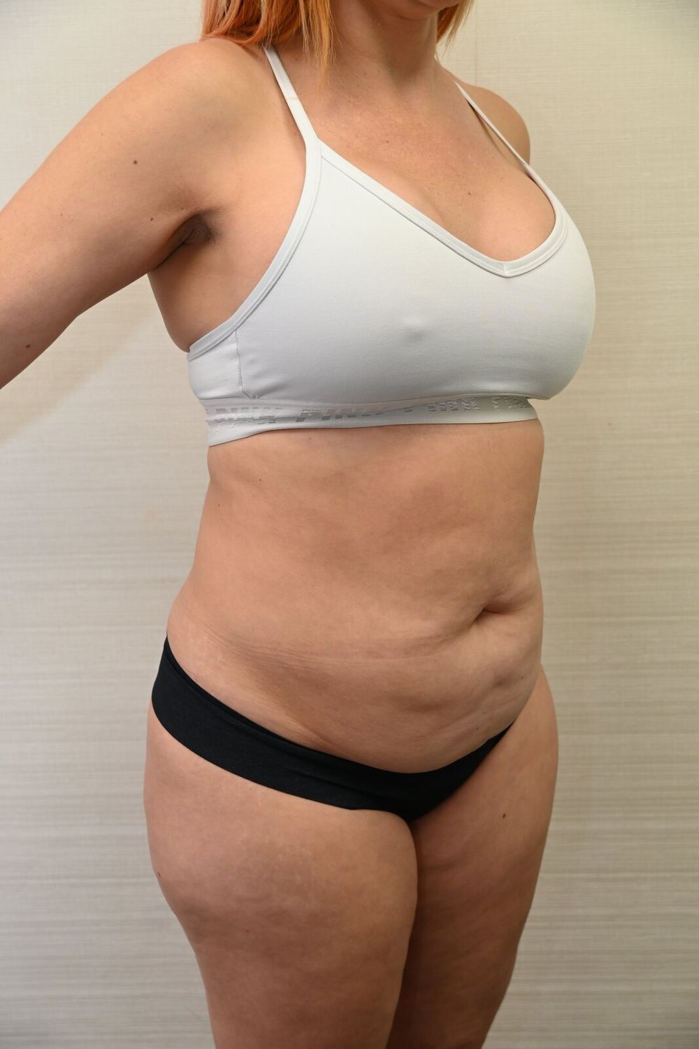 Abdominoplastia Before & After