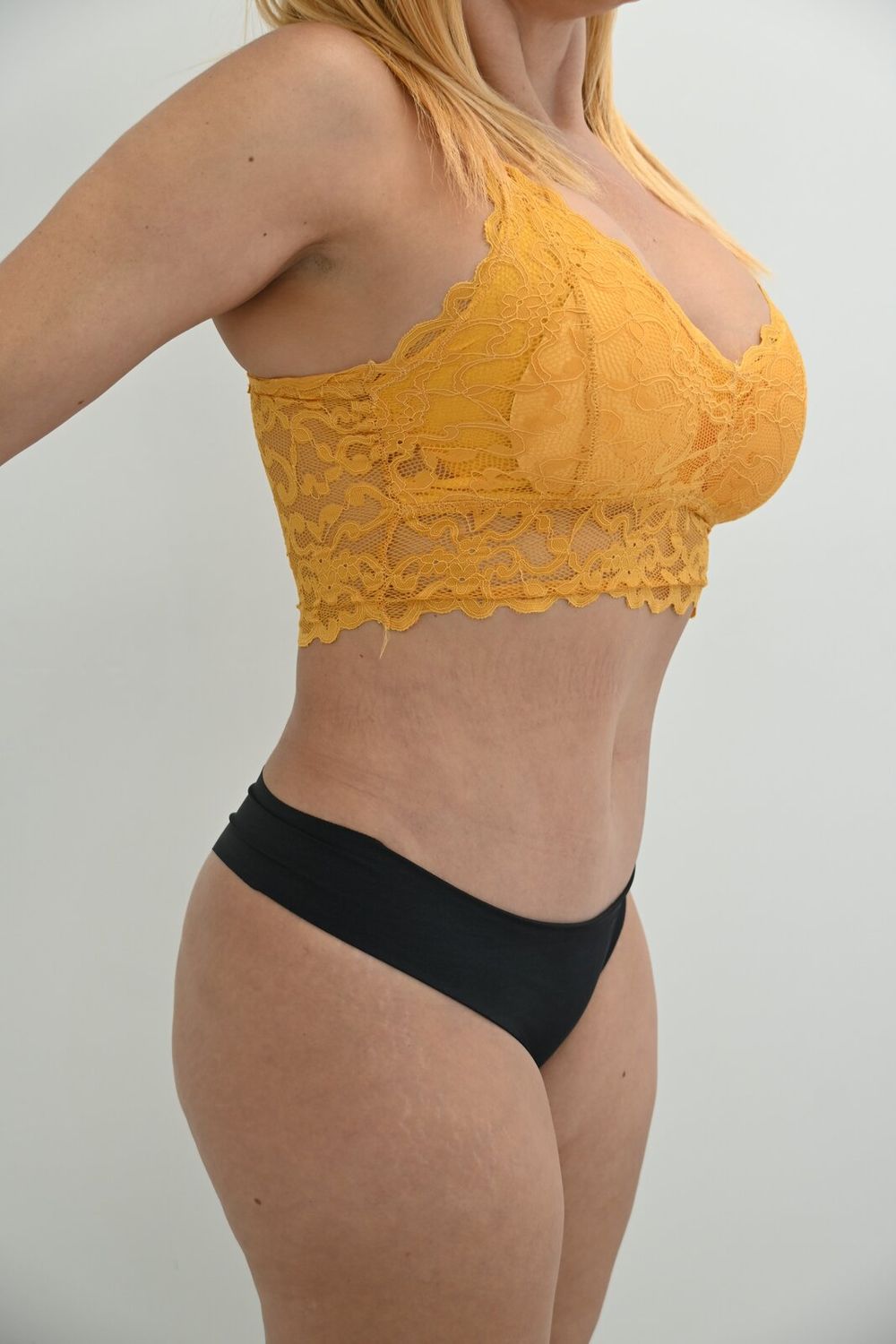 Abdominoplastia Before & After