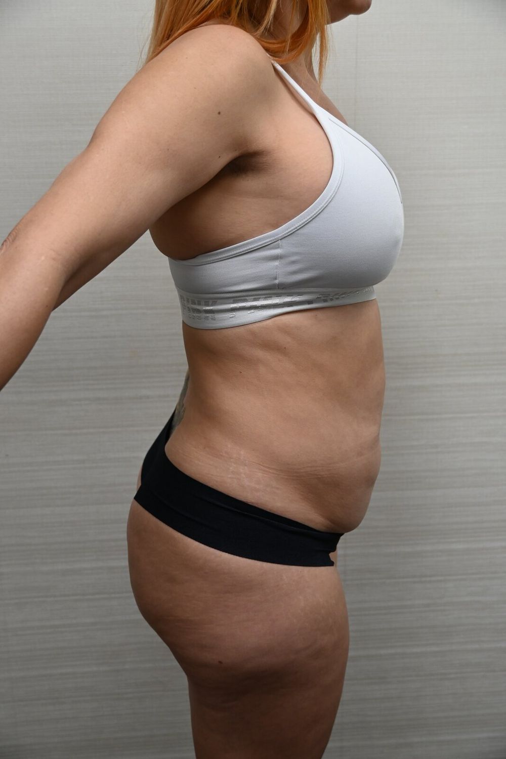 Abdominoplastia Before & After