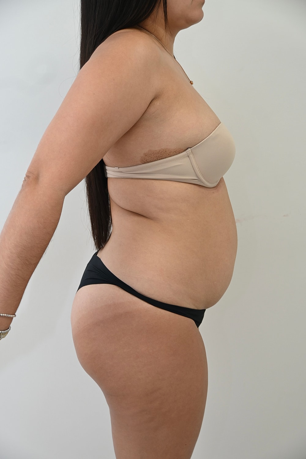 Abdominoplastia Before & After