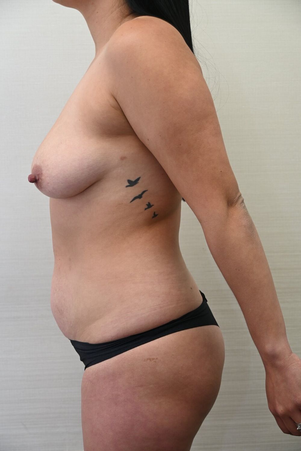 Abdominoplastia Before & After