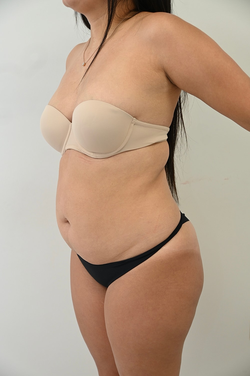 Abdominoplastia Before & After
