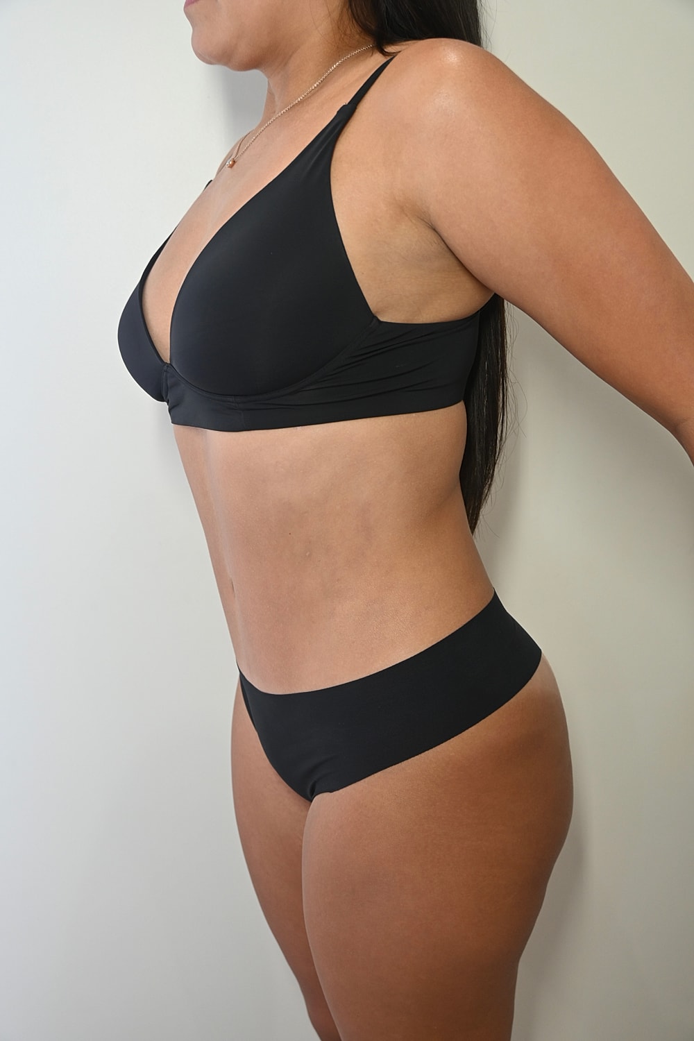 Abdominoplastia Before & After