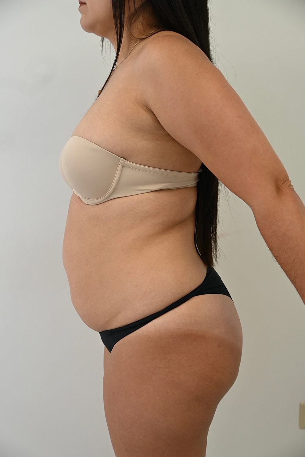 Abdominoplastia Before & After