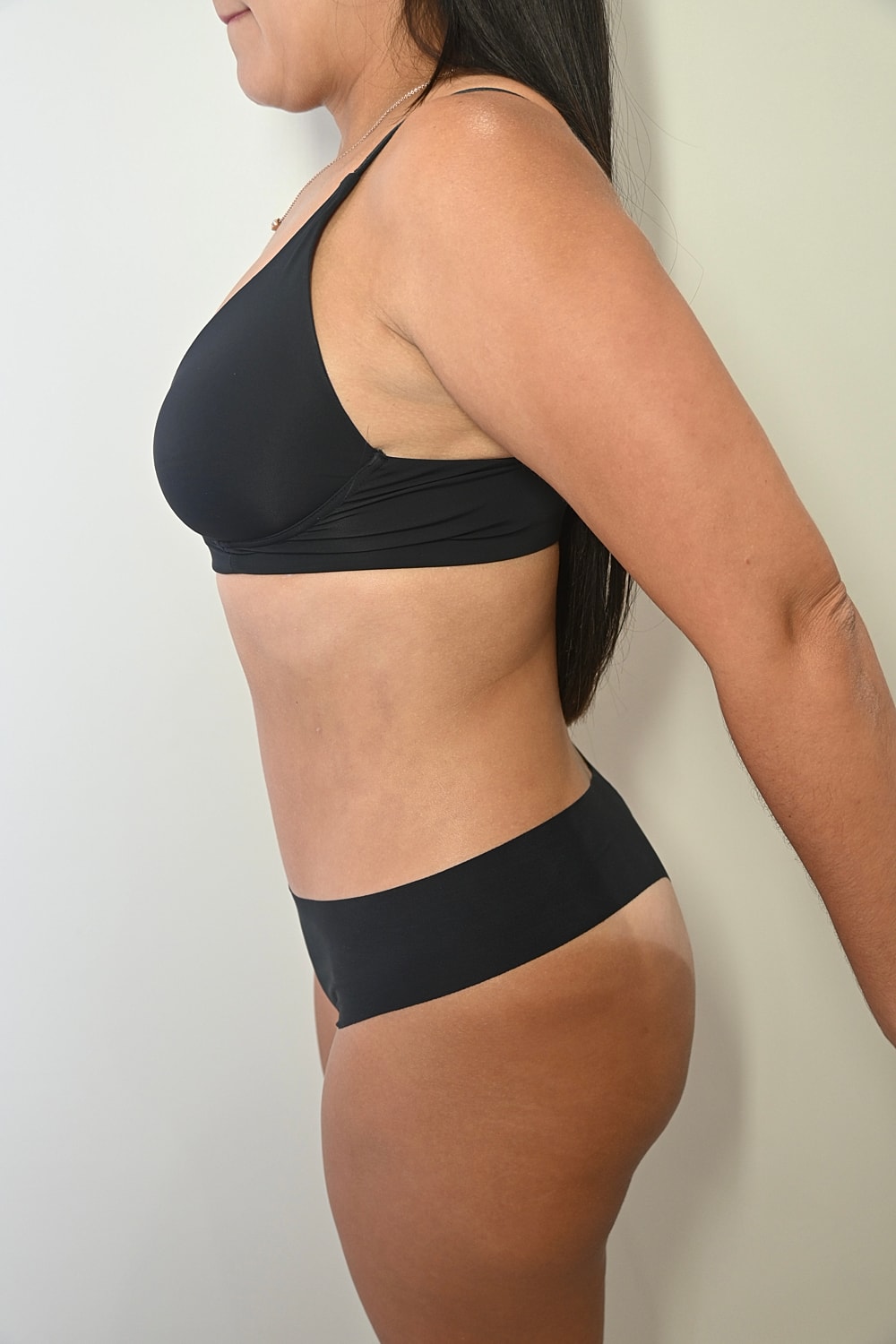 Abdominoplastia Before & After