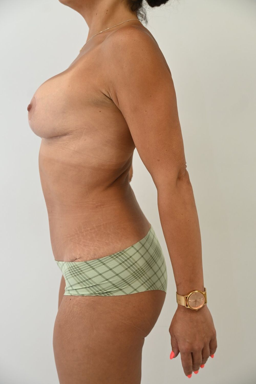 Abdominoplastia Before & After