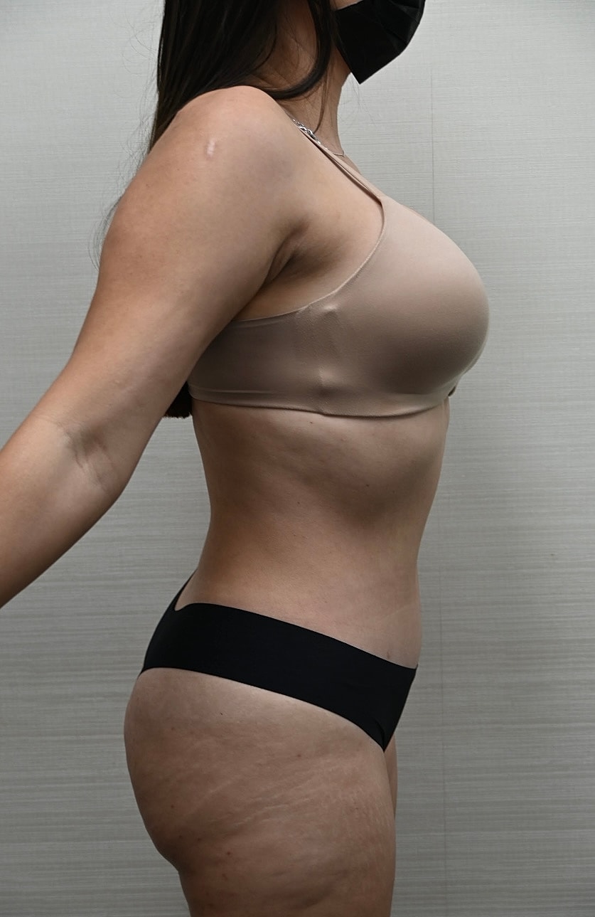 Abdominoplastia Before & After