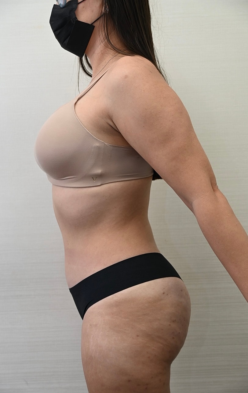 Abdominoplastia Before & After