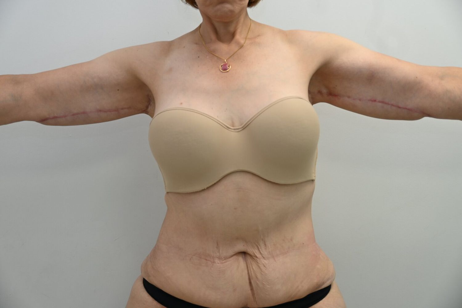 Braquioplastia Before & After