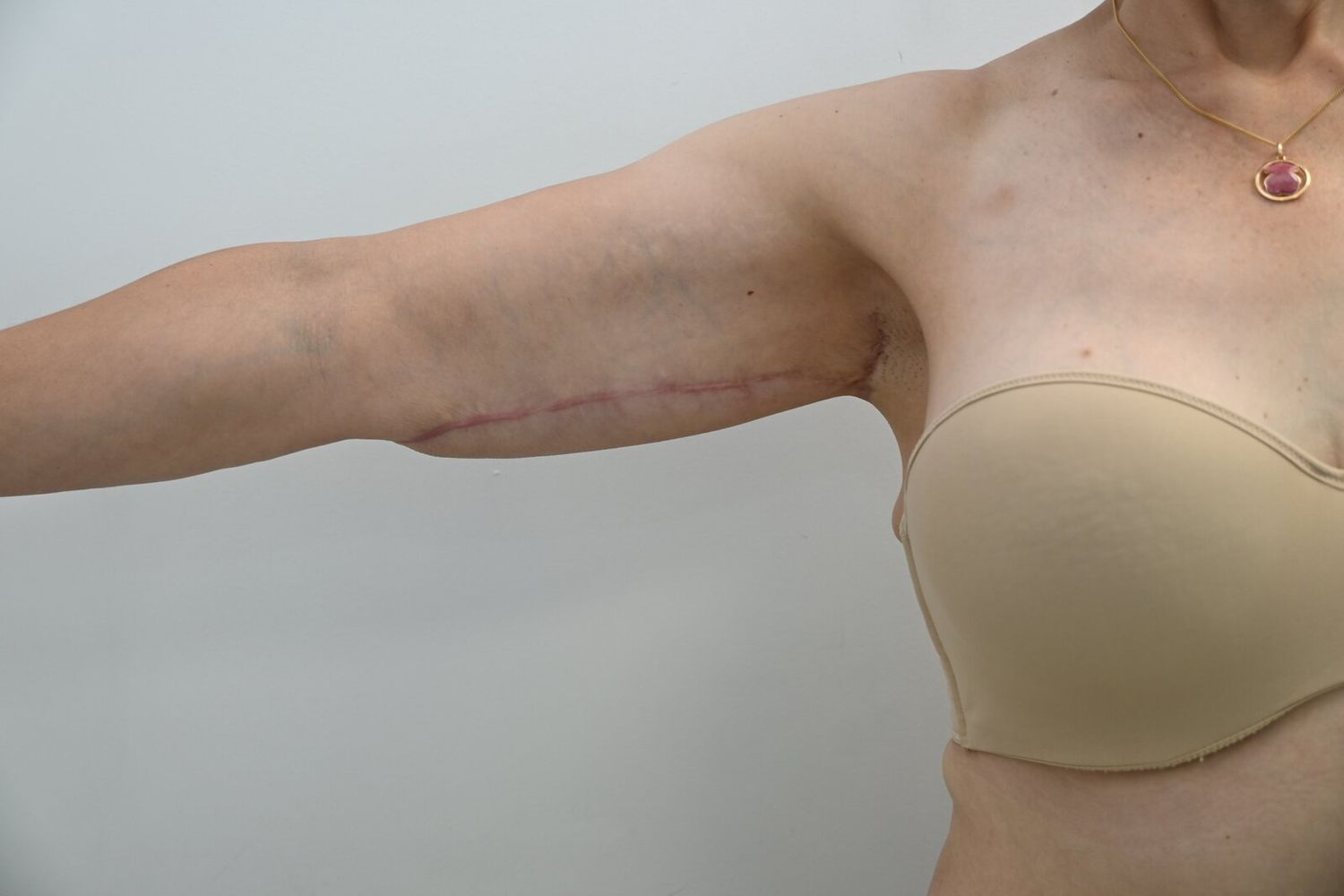 Braquioplastia Before & After