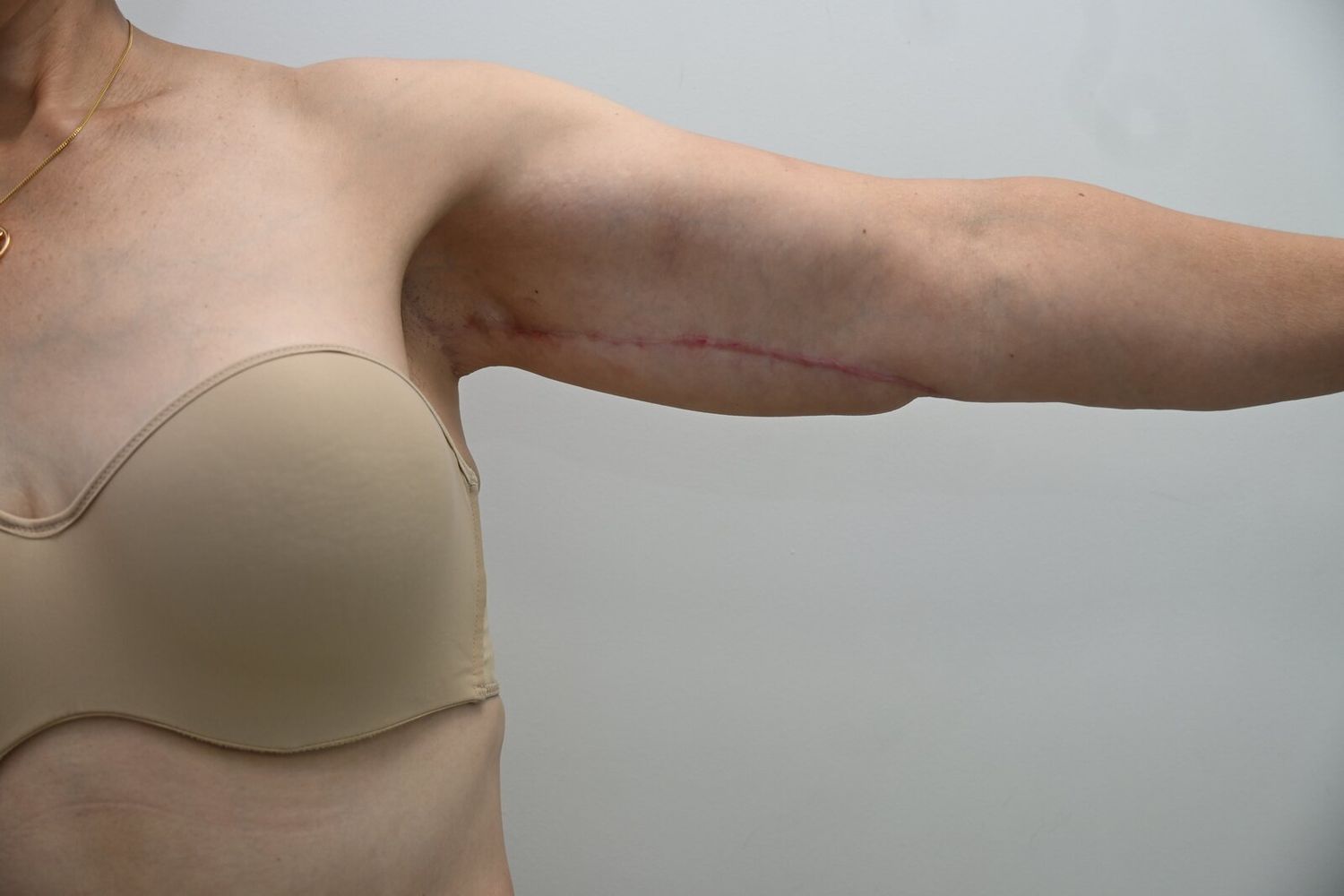 Braquioplastia Before & After