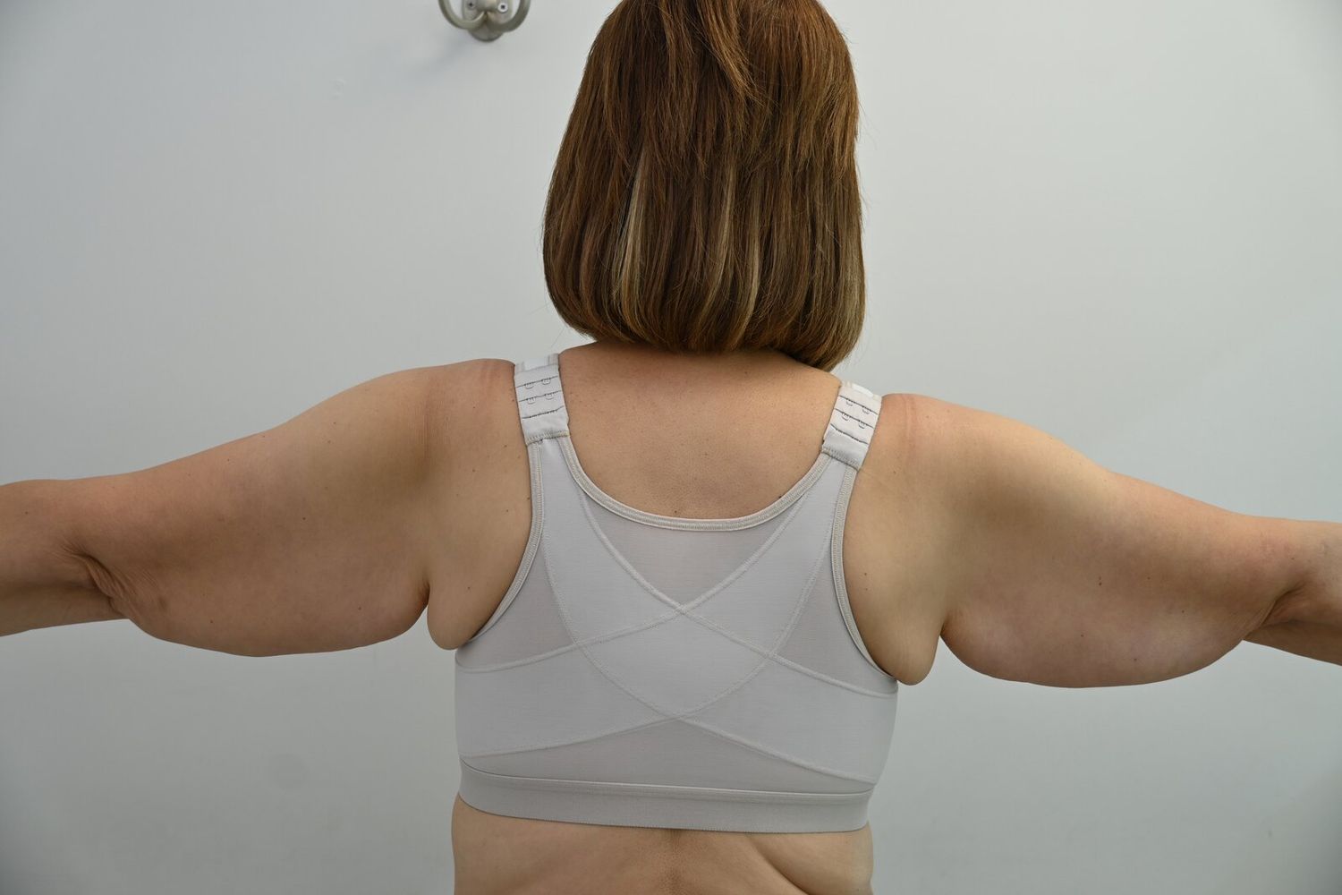 Braquioplastia Before & After