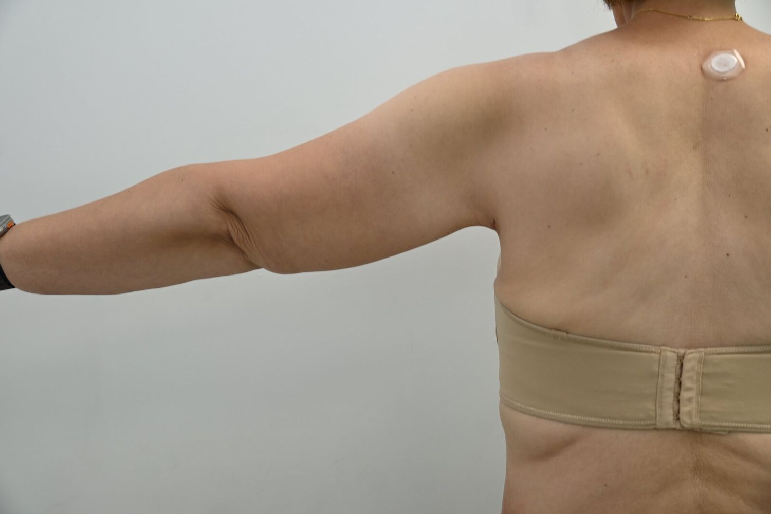 Braquioplastia Before & After