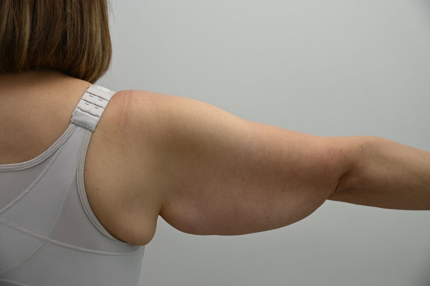 Braquioplastia Before & After