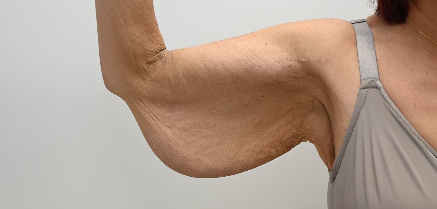 Braquioplastia Before & After