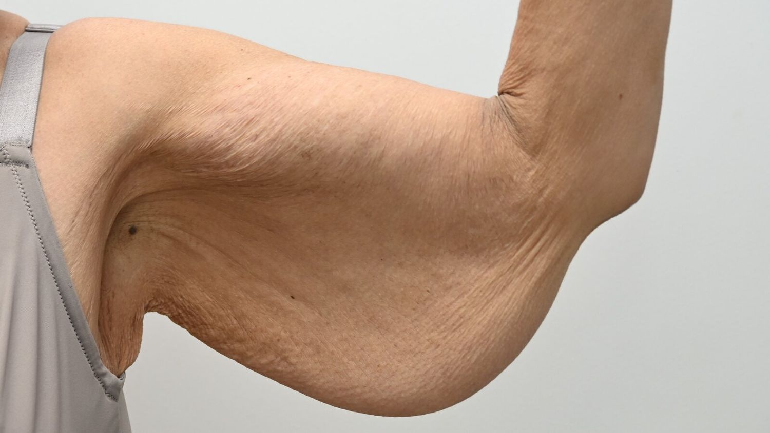 Braquioplastia Before & After