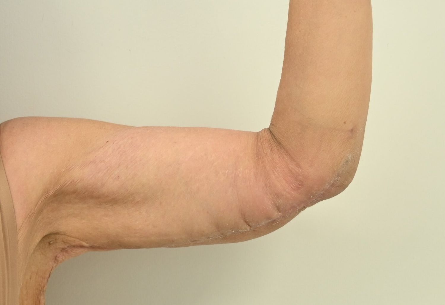 Braquioplastia Before & After