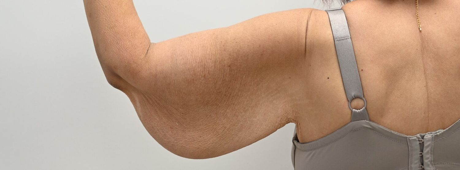 Braquioplastia Before & After