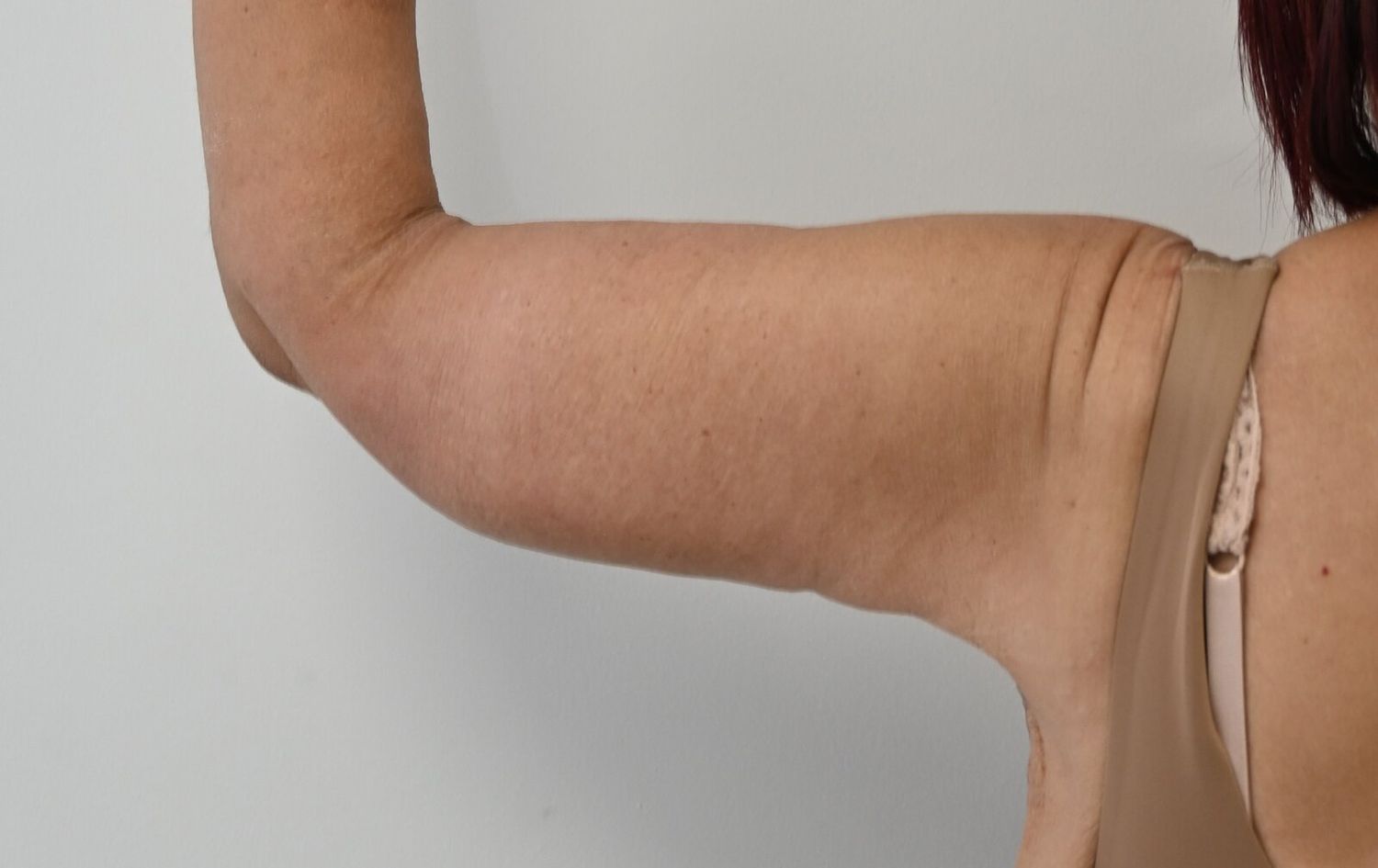 Braquioplastia Before & After