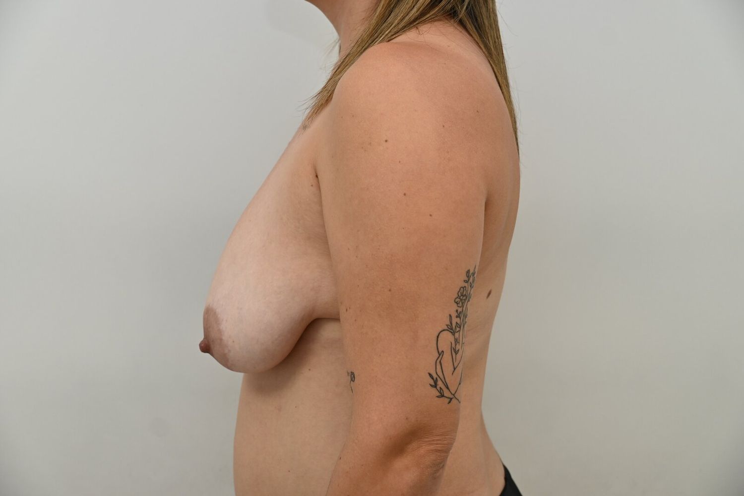 Reduccion De Senos Before & After