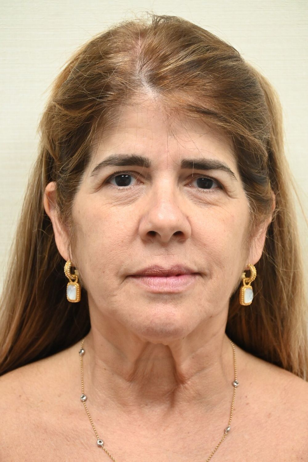 Estiramiento Facial Before & After