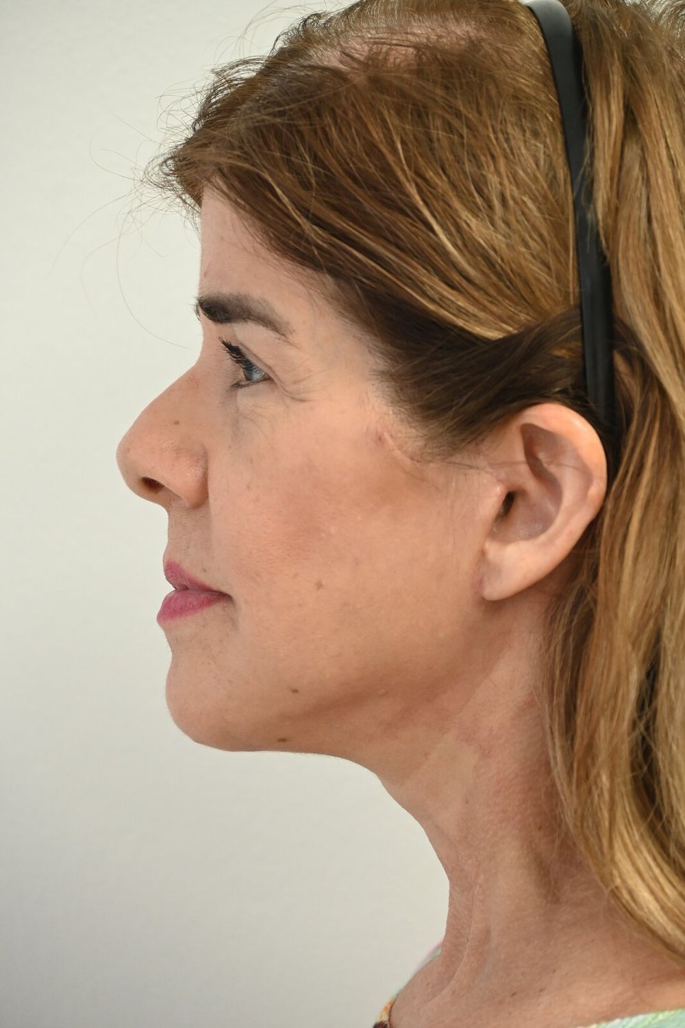 Estiramiento Facial Before & After