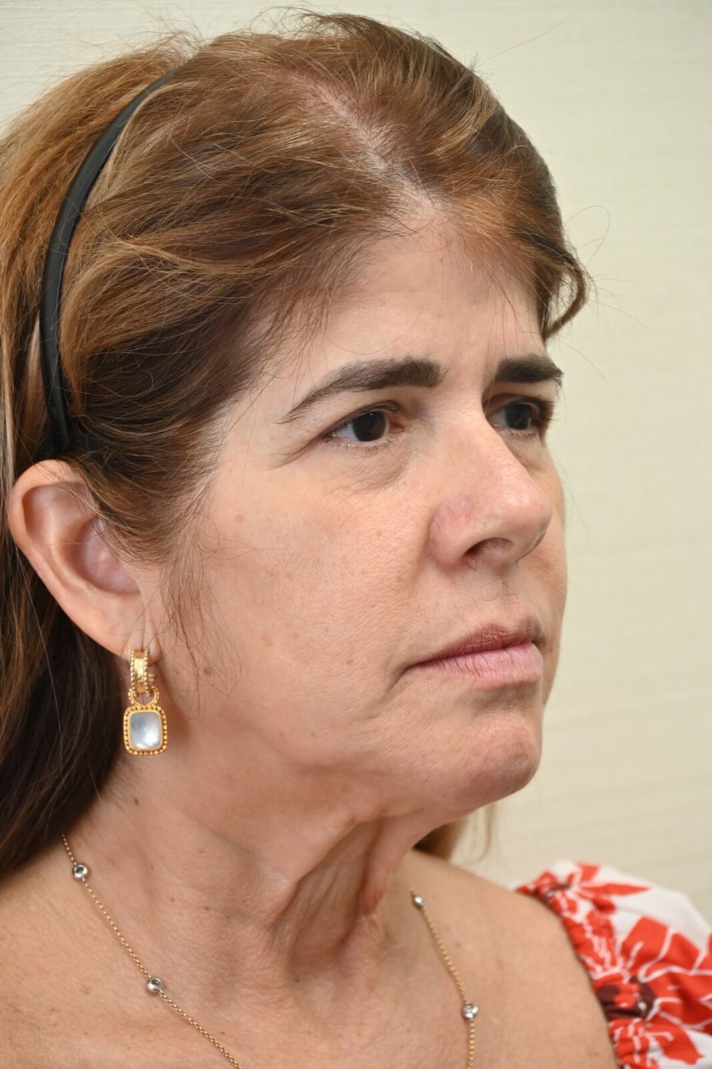 Estiramiento Facial Before & After