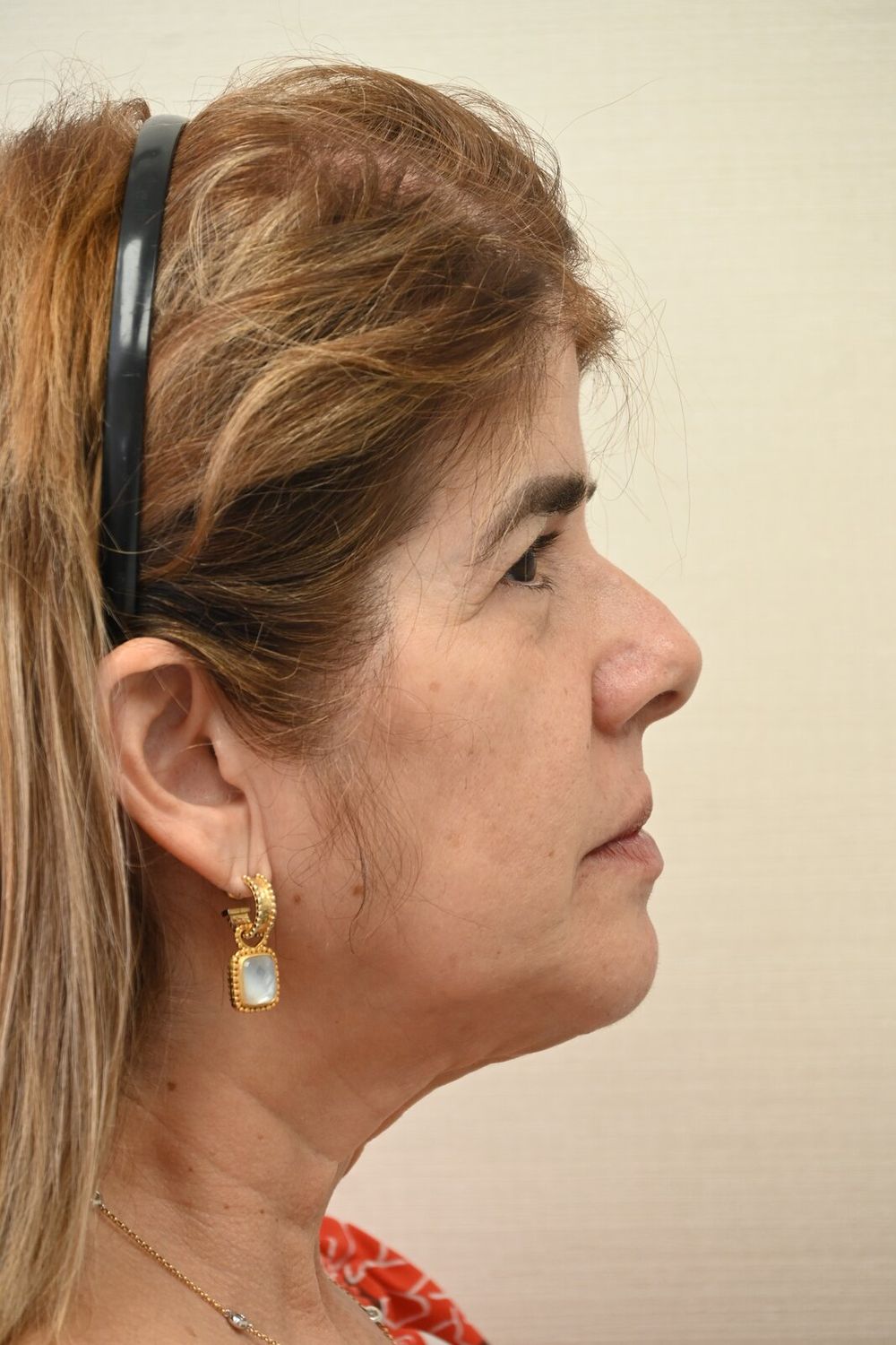 Estiramiento Facial Before & After