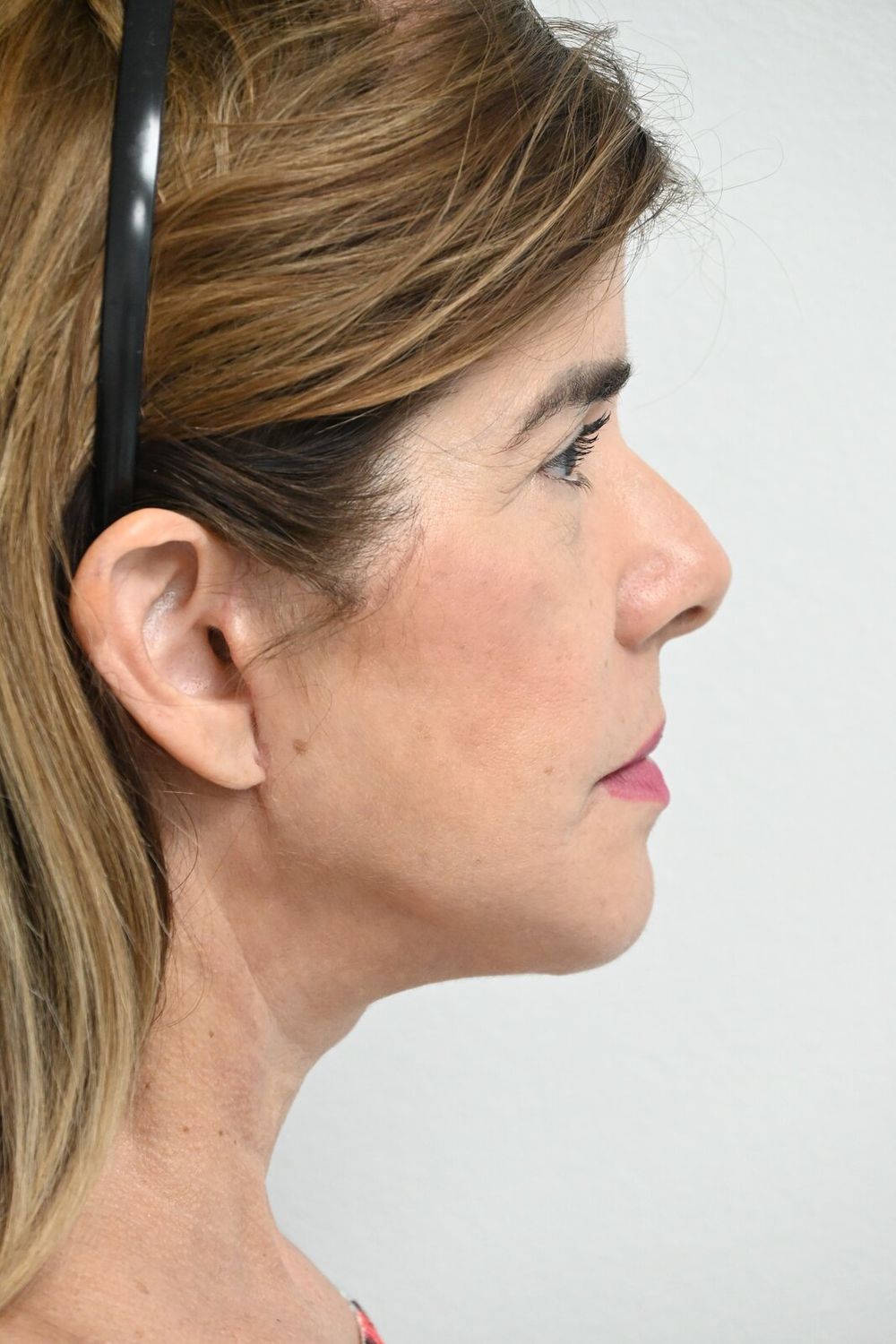 Estiramiento Facial Before & After