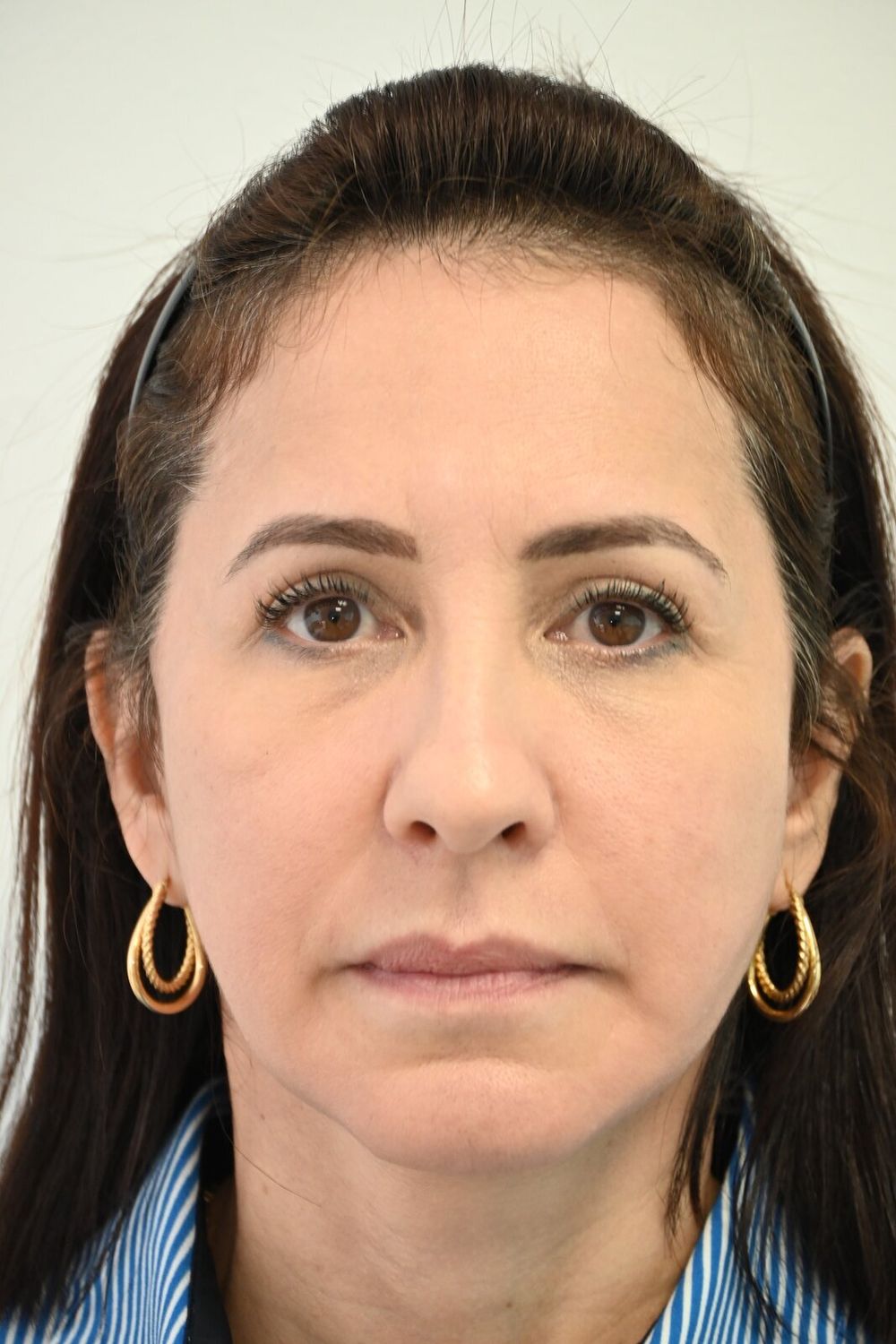 Estiramiento Facial Before & After