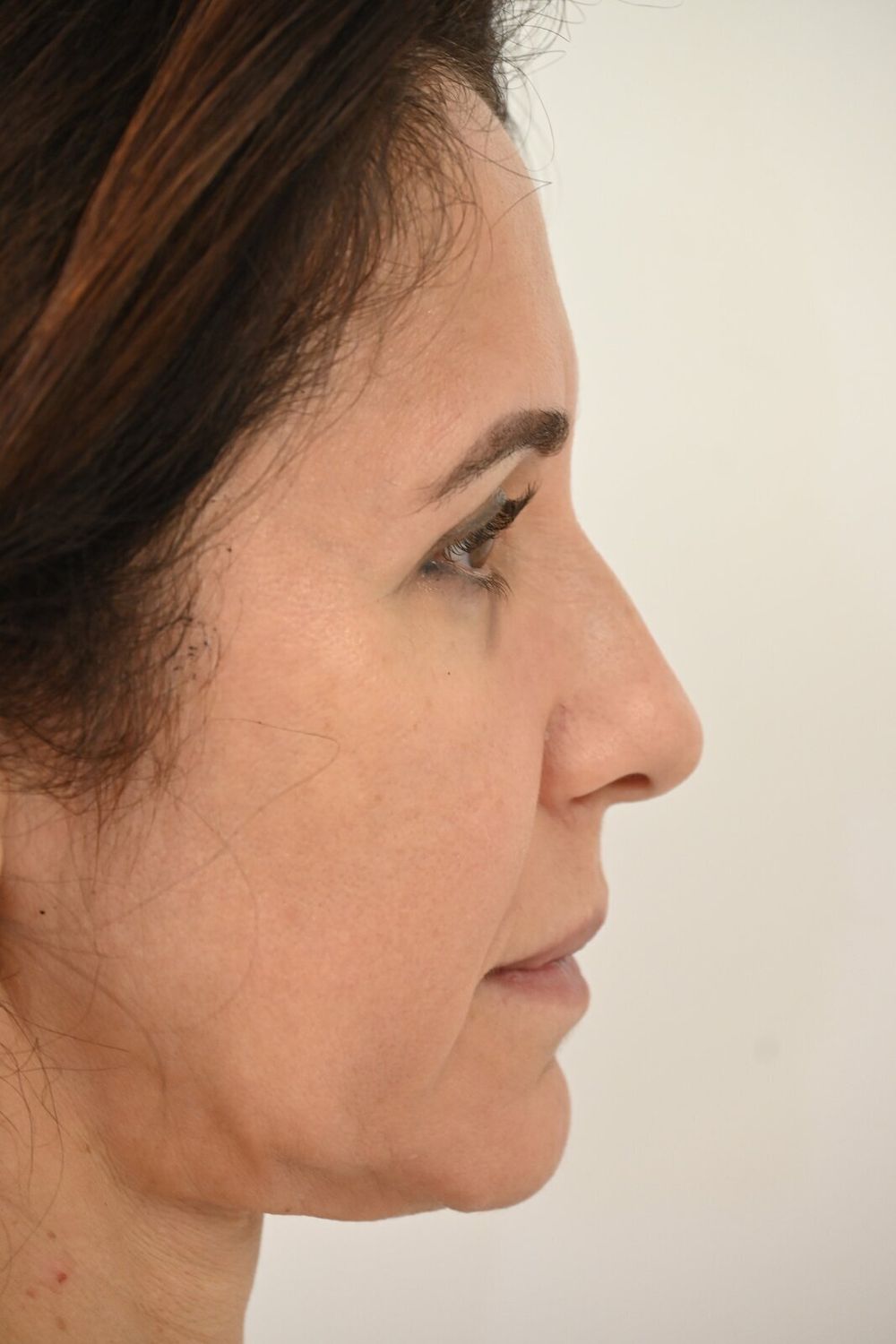 Estiramiento Facial Before & After