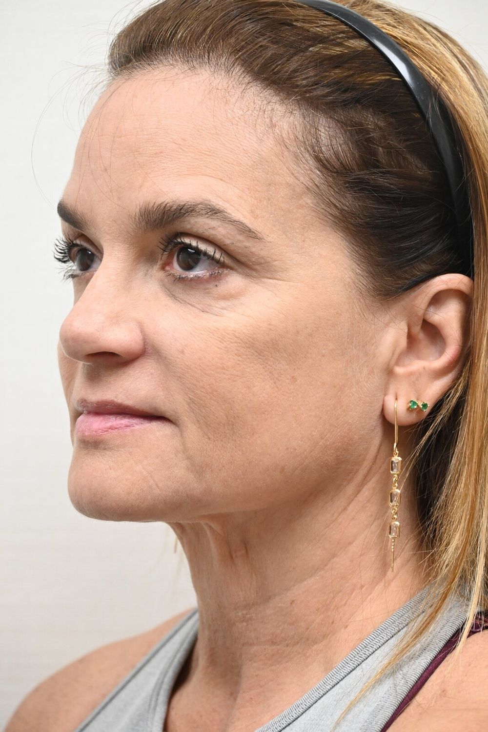 Estiramiento Facial Before & After