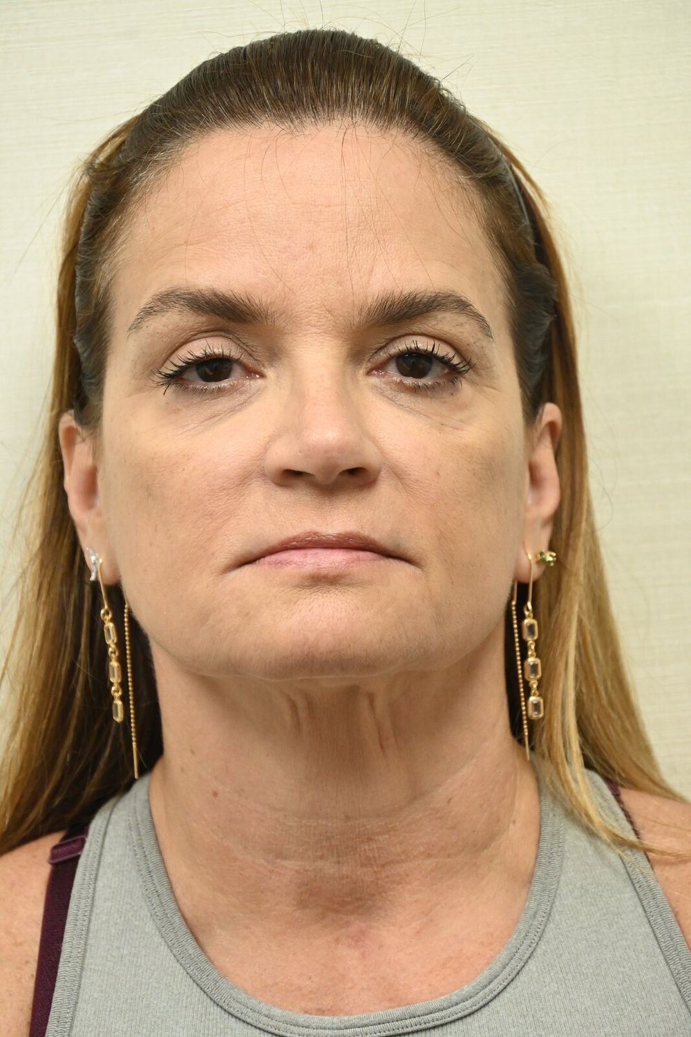 Estiramiento Facial Before & After